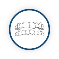 Crowded Teeth